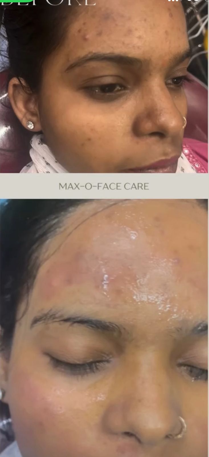 Acne Treatment Before & After